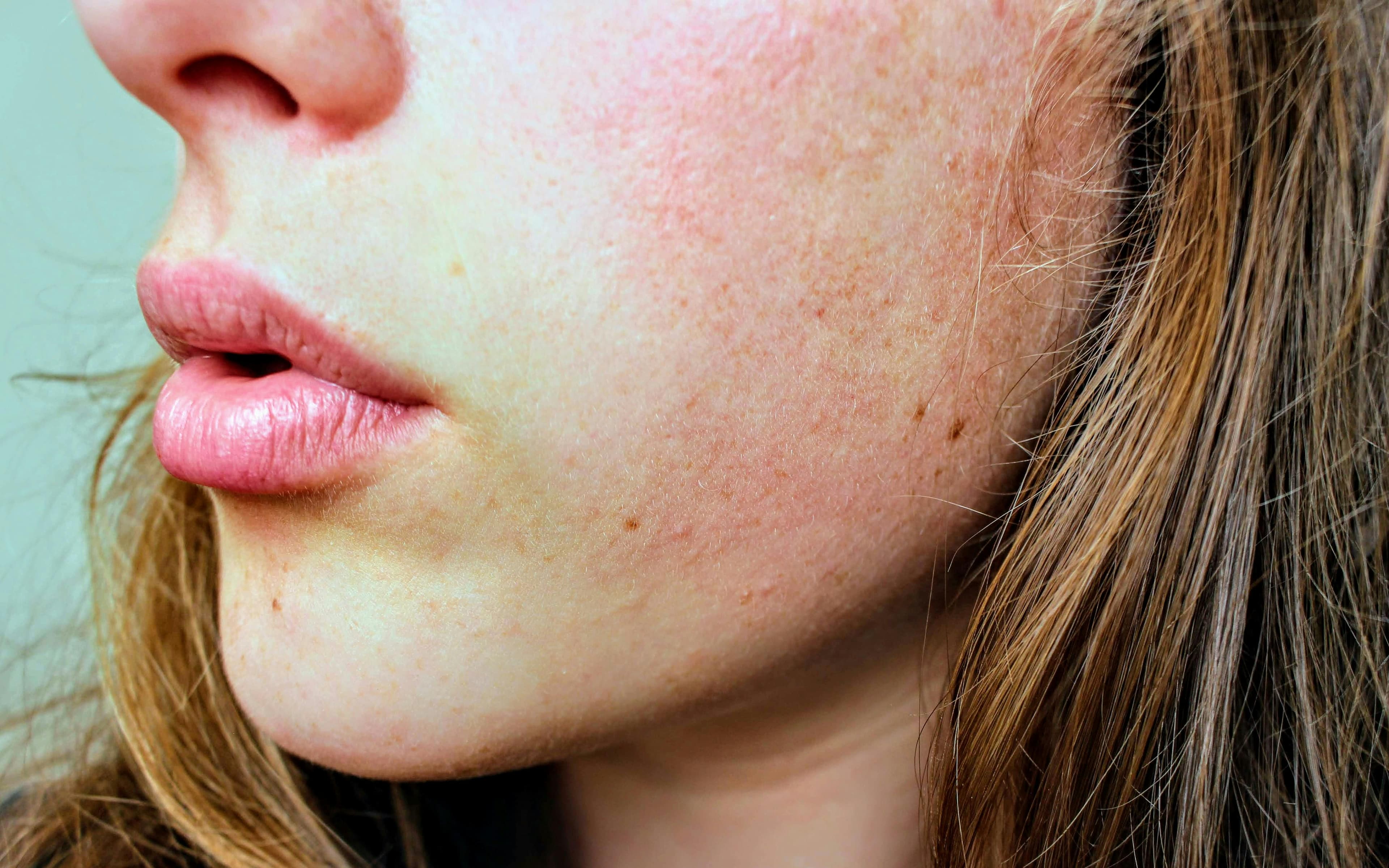 Skin Health